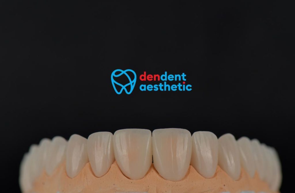 Emax Crowns