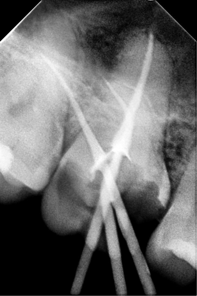 Root canal treatment procedure at Den Dent dental clinic