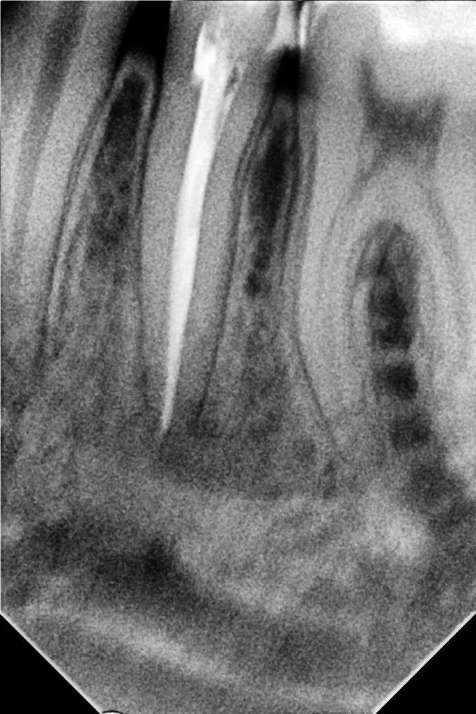Root canal treatment at den dent