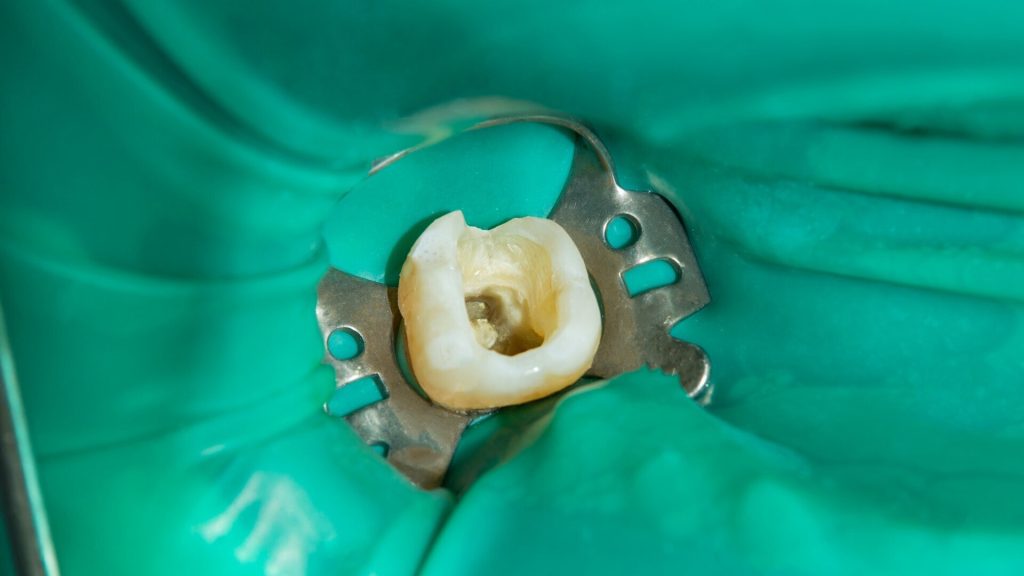 Root canal Ruberdam