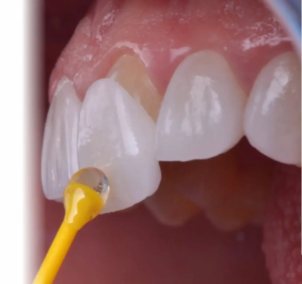 Porcelain Veneers